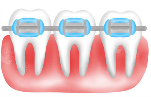 自锁矫正卡通图