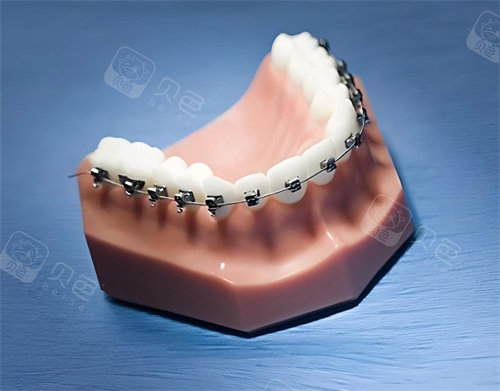 牙齿矫正模型展示图片