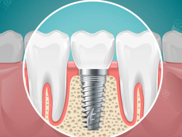愈合机台怎么识别型号瑞士ITI士卓曼种植体真伪查询方法：官网｜包装｜防伪标识等都能查!_https://www.jmylbn.com_新闻资讯_第7张