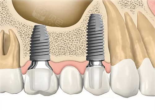 愈合机台怎么识别型号瑞士ITI士卓曼种植体真伪查询方法：官网｜包装｜防伪标识等都能查!_https://www.jmylbn.com_新闻资讯_第3张