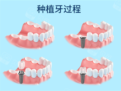 愈合机台怎么识别型号瑞士ITI士卓曼种植体真伪查询方法：官网｜包装｜防伪标识等都能查!_https://www.jmylbn.com_新闻资讯_第2张