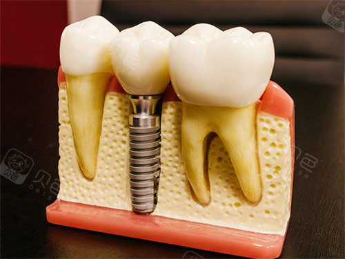 愈合机台怎么识别型号瑞士ITI士卓曼种植体真伪查询方法：官网｜包装｜防伪标识等都能查!_https://www.jmylbn.com_新闻资讯_第1张