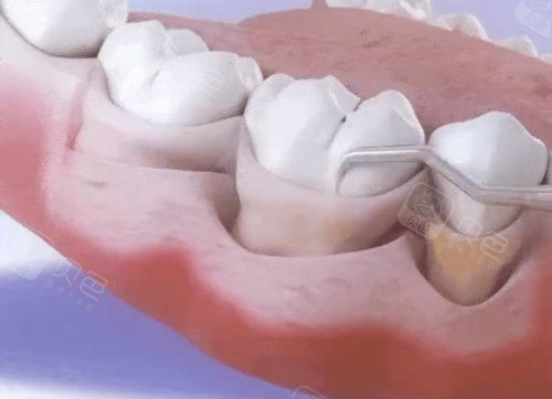 水激光牙周治疗多少钱一次？轻度/中度/重度费用差异大吗