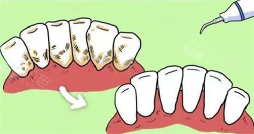 牙周炎未控制能补牙吗？这四类有补牙需求的患者必须优先处理牙周问题