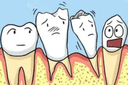 牙周炎未控制能补牙吗？这四类有补牙需求的患者必须优先处理牙周问题