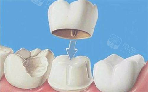 义获嘉全瓷牙价格表分享，单颗1500元起！