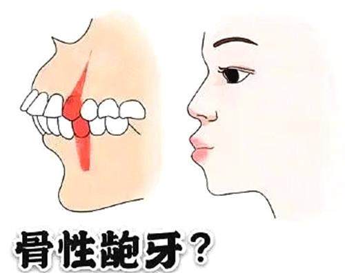 正颌手术VS普通正畸：骨性龅牙该选哪种？一张图看懂差异！