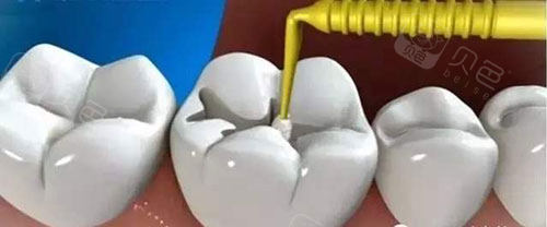 慈利补牙价格大盘点！光固化树脂280元+瓷嵌体1000元，哪种适合你？