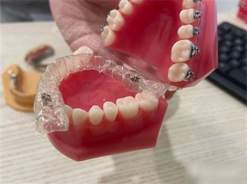 牙齿矫正隐形牙套模型