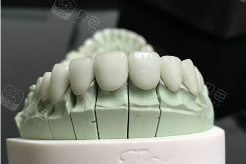 威兰德全瓷牙1600元是真的吗？正规款2000起，低价多缺工艺或是冒充