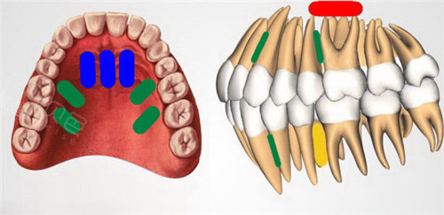 牙齿矫正方案设计