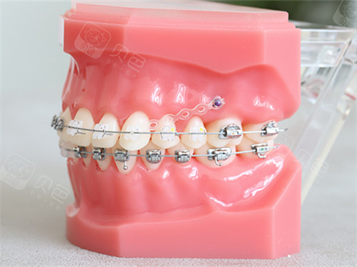 牙齿矫正金属及陶瓷托槽牙套模型图