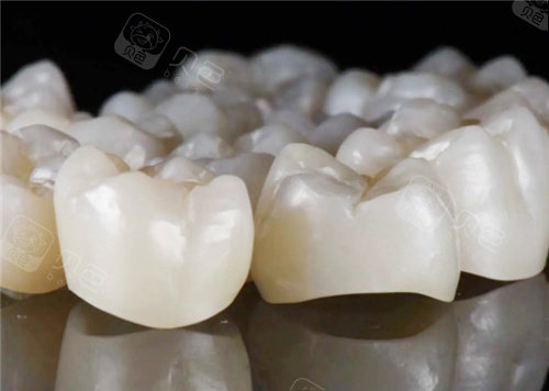 威兰德全瓷牙多少钱一颗？分享威兰德全瓷牙价格表、使用寿命及优缺点