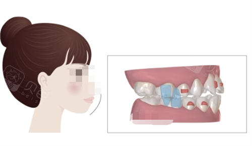 正雅隐形矫正S8突面矫正展示