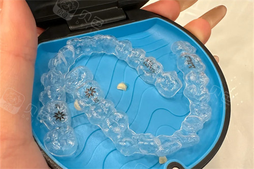 美国隐适美适合什么人群?我追求进口品质,隐适美矫正超放心