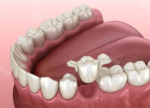 想知道马里兰桥好还是镶牙好？先了解价格|使用寿命|美观性等方面的差异