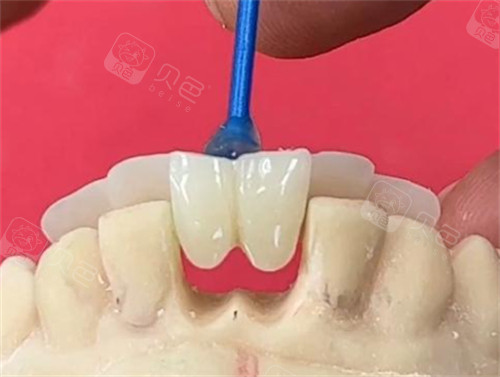 想知道马里兰桥好还是镶牙好？先了解价格|使用寿命|美观性等方面的差异