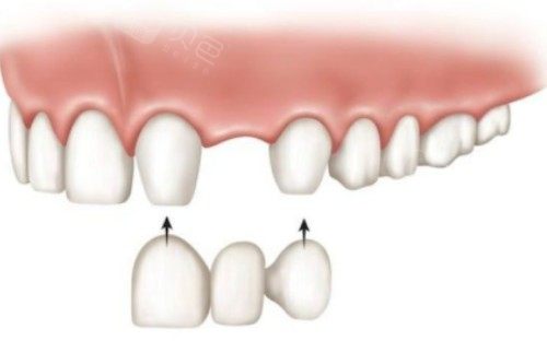 镶牙安装卡通图