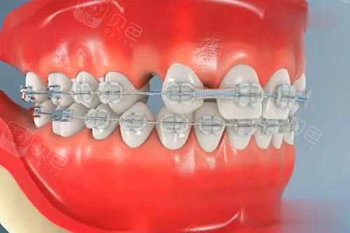 牙齿矫正模型漫画