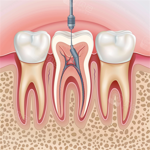 日照牙齿根管治疗要多少钱？前牙480起/后牙880起！