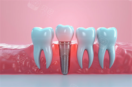 种植牙漫画模型解剖图