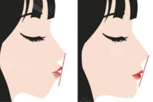 口呼吸导致的嘴凸可以矫正吗？及早干预+综合措施可改善面部形态