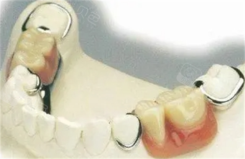 口腔护理包怎么用老年人假牙牙龈长包别慌!实用假牙款式+护理妙招,辈轻松解决困扰_https://www.jmylbn.com_新闻资讯_第4张