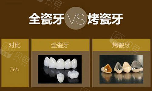 全瓷牙5年后真实感受:600元vs2800元全瓷牙差距多大?低价易崩瓷