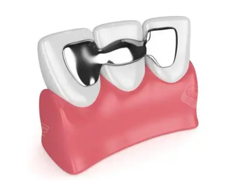 马里兰桥牙好不好？分享马里兰桥牙优缺点、适应症、价格及使用年限