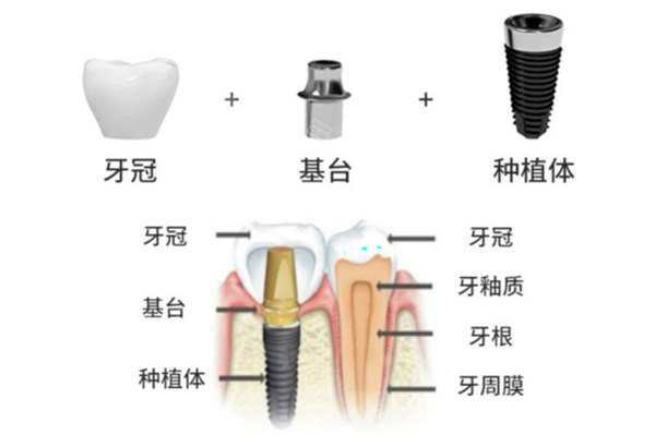 哈尔滨种植牙集采价格是多少钱？附各品牌集采后价格明细！