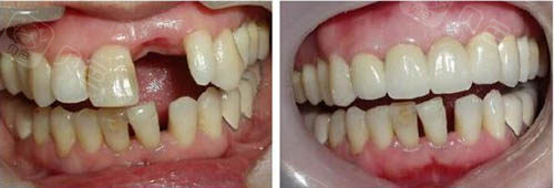 种植牙手术前后图