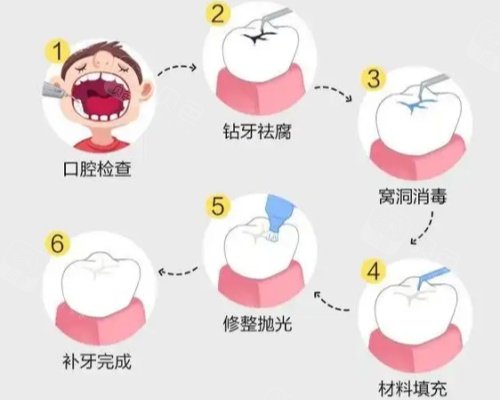dmg口腔材料怎么使用常见十个补牙材料品牌盘点｜美国3M／义获嘉／VOCO／等全解析_https://www.jmylbn.com_新闻资讯_第10张