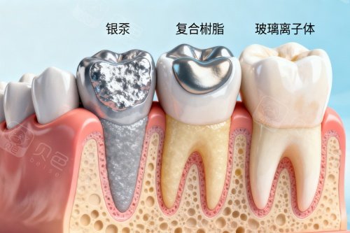 补牙材料卡通图展示