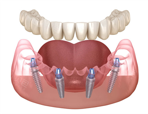半口种植牙动画图示