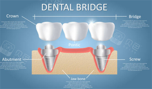 种植牙连桥冠示意图
