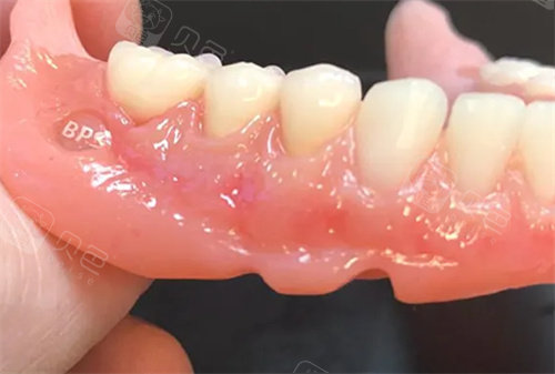 口腔吸盘怎么安装吸附式假牙的优点和缺点分别是什么呢？一文读懂“吸盘式”假牙的利与弊_https://www.jmylbn.com_新闻资讯_第6张