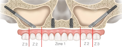 穿颧穿翼种植分区图解