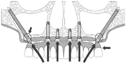 穿颧穿翼种植牙示意图