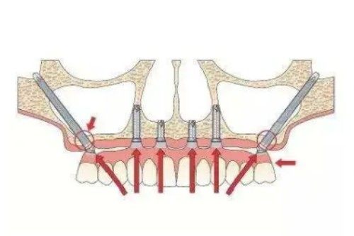 穿颧穿翼种植卡通图片展示