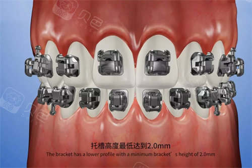 forestadent怎么读自锁托槽矫正哪个牌子好？揭秘2026自锁托槽矫正十大品牌排行榜_https://www.jmylbn.com_新闻资讯_第4张