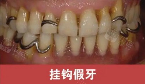 挂钩假牙展示示意图