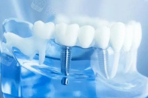 超声骨刀 哪些品牌种植牙一千多和几千的区别是什么？一文说透价格背后的真相！_https://www.jmylbn.com_新闻资讯_第6张