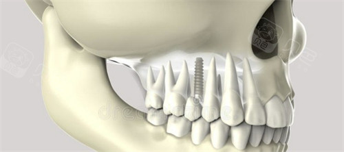 超声骨刀 哪些品牌种植牙一千多和几千的区别是什么？一文说透价格背后的真相！_https://www.jmylbn.com_新闻资讯_第10张