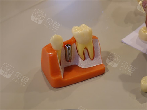 超声骨刀 哪些品牌种植牙一千多和几千的区别是什么？一文说透价格背后的真相！_https://www.jmylbn.com_新闻资讯_第9张