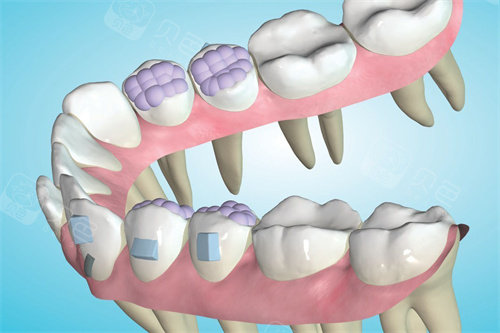 Spark精靓隐形矫正器方案设计时可以看到牙根