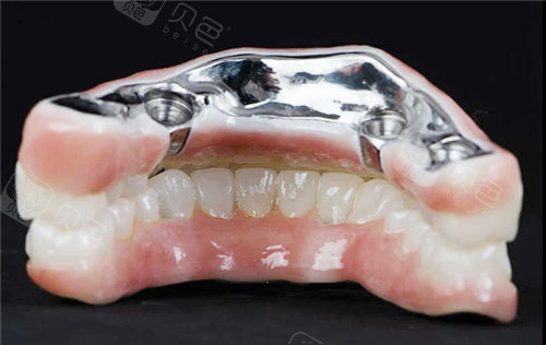 钛合金全口义齿