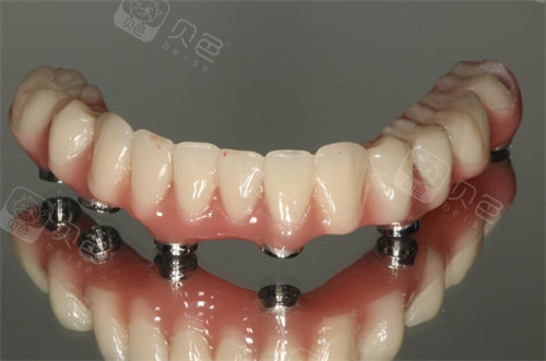 全口种植牙下颌