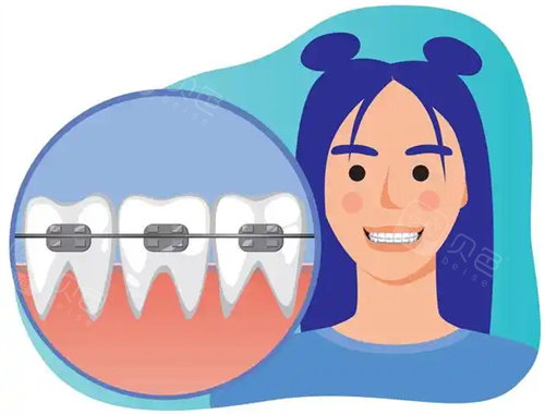 儿童牙齿矫正卡通图
