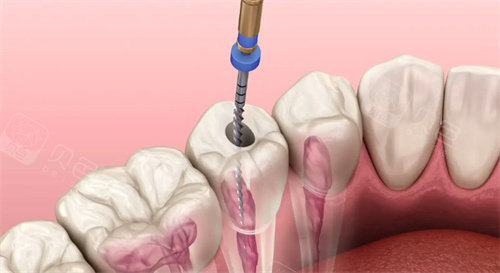 根管治疗动画示意图