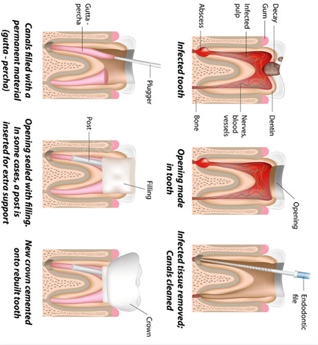 根管治疗过程图